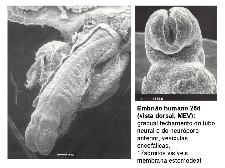 Embrião humano 26 d (vista dorsal, MEV): gradual fechamento do tubo neural e do