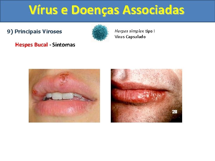 Vírus e Doenças Associadas 9) Principais Viroses Hespes Bucal - Sintomas Herpes simplex tipo