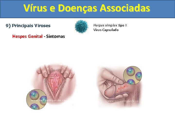 Vírus e Doenças Associadas 9) Principais Viroses Hespes Genital - Sintomas Herpes simplex tipo