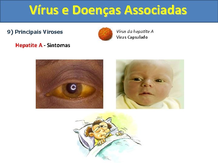 Vírus e Doenças Associadas 9) Principais Viroses Hepatite A - Sintomas Vírus da hepatite