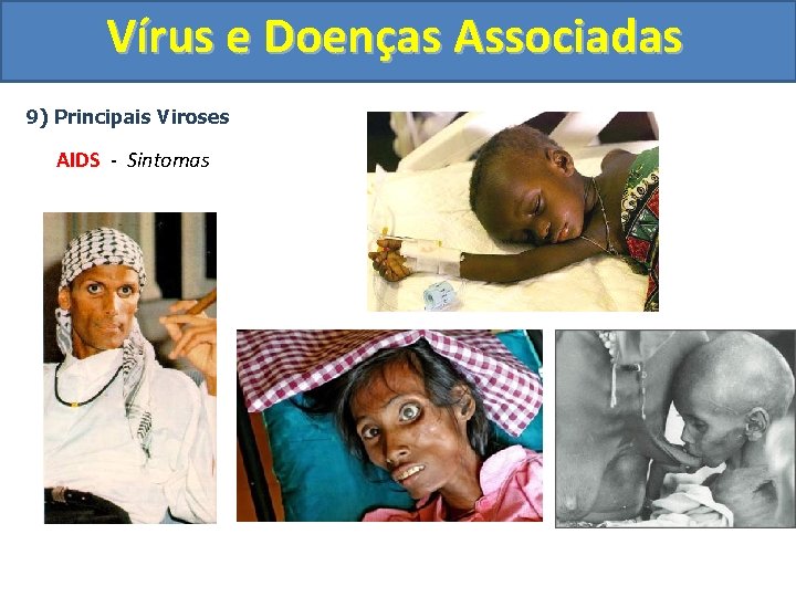 Vírus e Doenças Associadas 9) Principais Viroses AIDS - Sintomas 