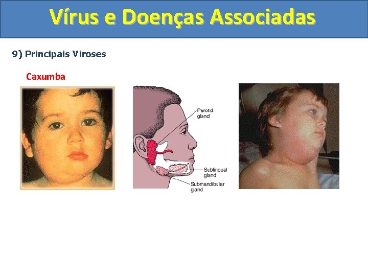 Vírus e Doenças Associadas 9) Principais Viroses Caxumba 