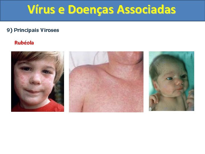 Vírus e Doenças Associadas 9) Principais Viroses Rubéola 