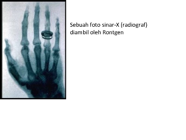 Sebuah foto sinar-X (radiograf) diambil oleh Rontgen 