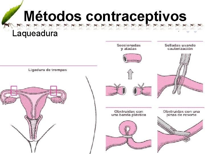 Métodos contraceptivos Laqueadura www. andremaiabio. com. br 