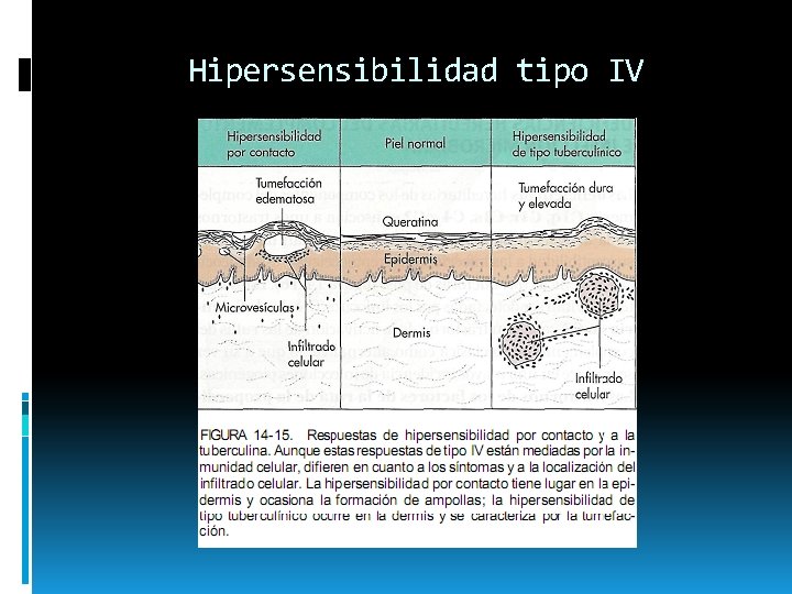 Hipersensibilidad tipo IV 