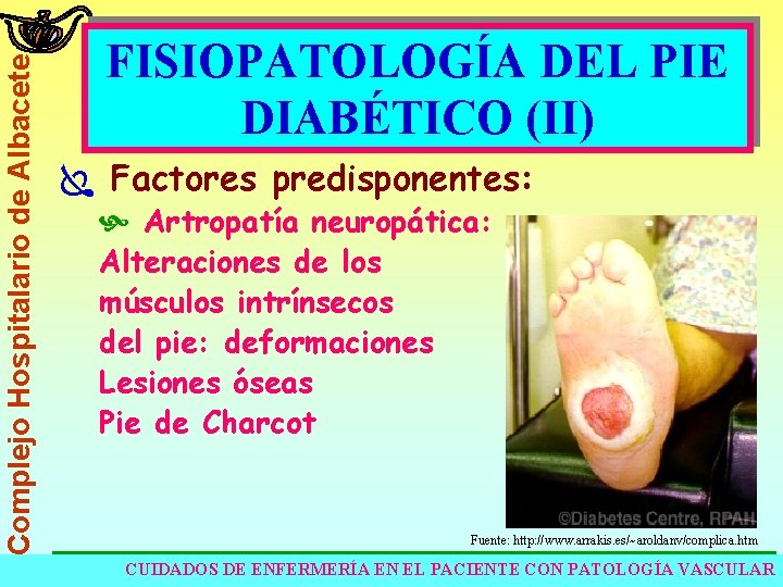 Complejo Hospitalario de Albacete FISIOPATOLOGÍA DEL PIE DIABÉTICO (II) Ï Factores predisponentes: Artropatía neuropática: