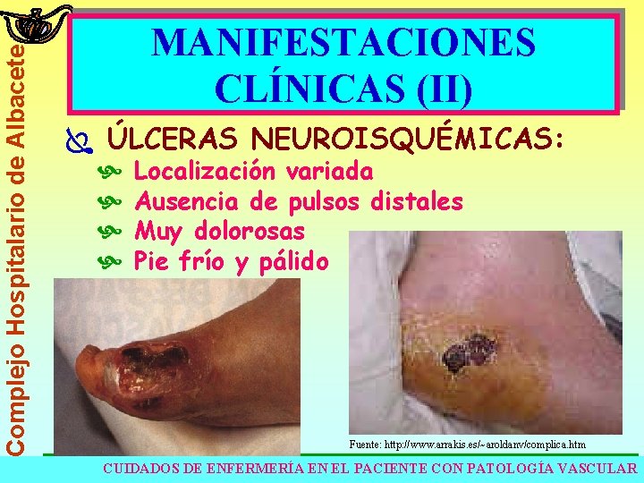 Complejo Hospitalario de Albacete MANIFESTACIONES CLÍNICAS (II) Ï ÚLCERAS NEUROISQUÉMICAS: Localización variada Ausencia de