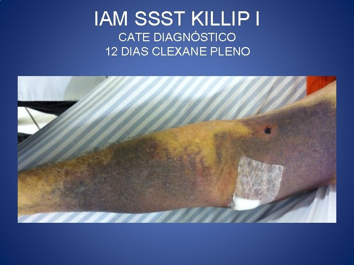 IAM SSST KILLIP I CATE DIAGNÓSTICO 12 DIAS CLEXANE PLENO 