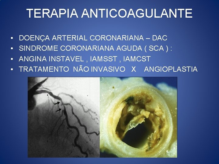 TERAPIA ANTICOAGULANTE • • DOENÇA ARTERIAL CORONARIANA – DAC SINDROME CORONARIANA AGUDA ( SCA