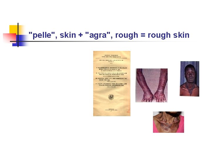 "pelle", skin + "agra", rough = rough skin 