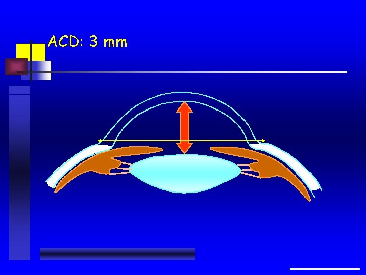 ACD: 3 mm 