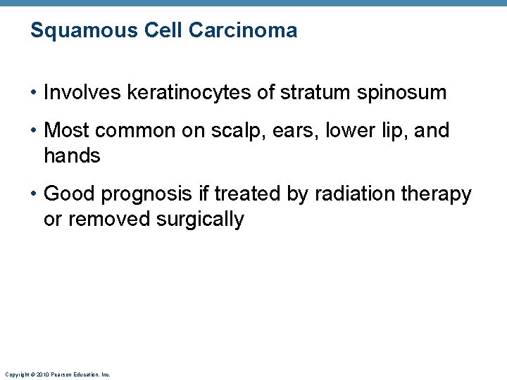 Squamous Cell Carcinoma • Involves keratinocytes of stratum spinosum • Most common on scalp, Squamous Cell Carcinoma • Involves keratinocytes of stratum spinosum • Most common on scalp,