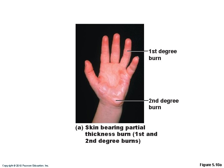 1 st degree burn 2 nd degree burn (a) Skin bearing partial thickness burn