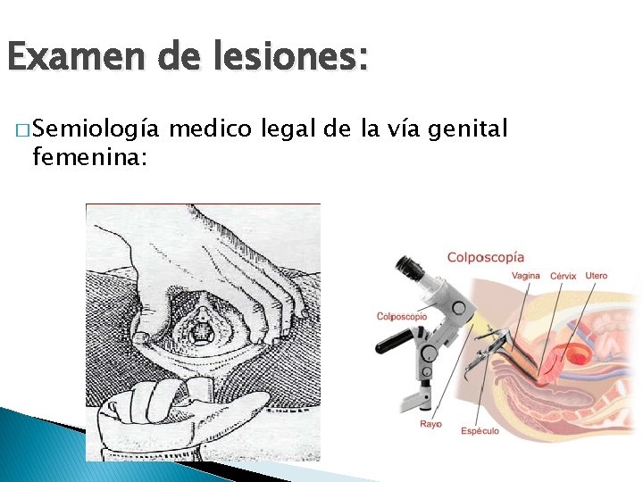 Examen de lesiones: � Semiología femenina: medico legal de la vía genital 