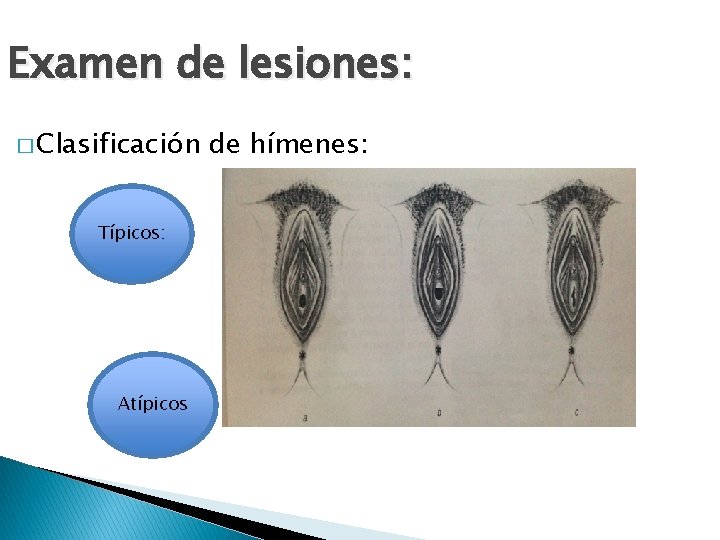 Examen de lesiones: � Clasificación Típicos: Atípicos de hímenes: 