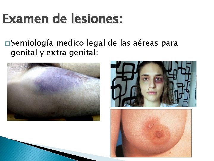 Examen de lesiones: � Semiología medico legal de las aéreas para genital y extra