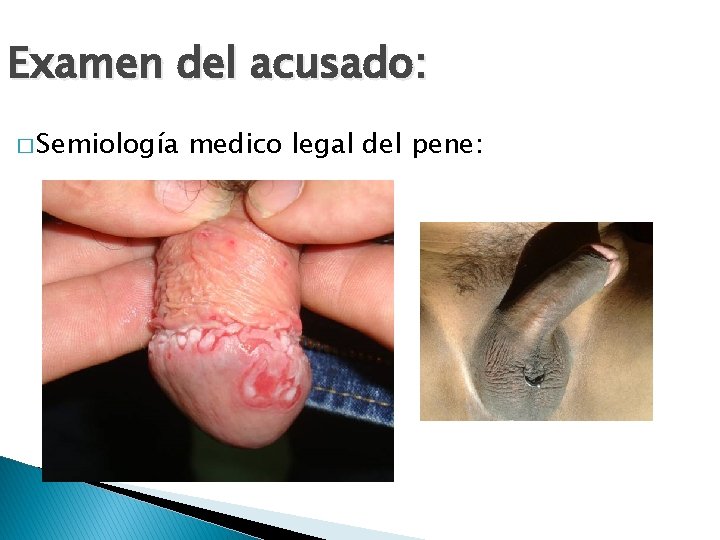 Examen del acusado: � Semiología medico legal del pene: 