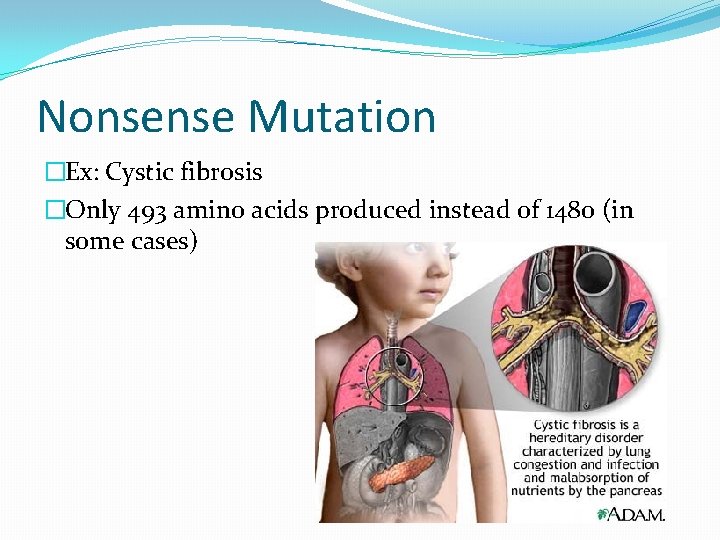 Nonsense Mutation �Ex: Cystic fibrosis �Only 493 amino acids produced instead of 1480 (in