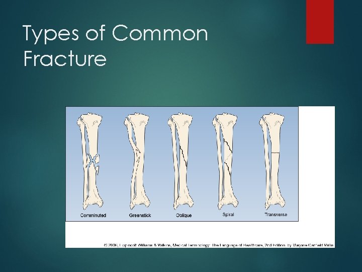 Types of Common Fracture 