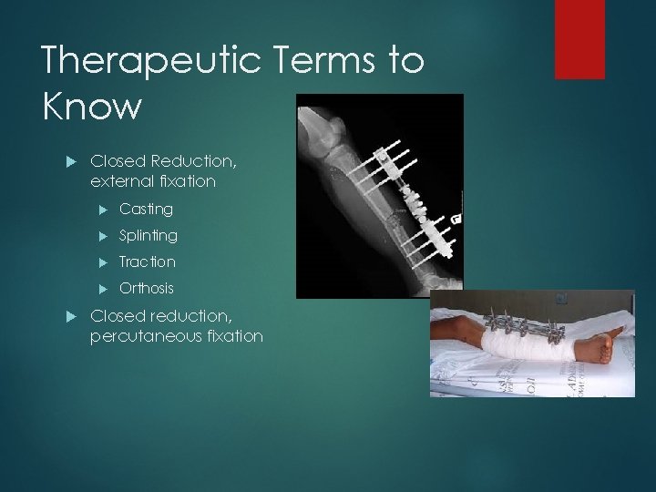 Therapeutic Terms to Know Closed Reduction, external fixation Casting Splinting Traction Orthosis Closed reduction,