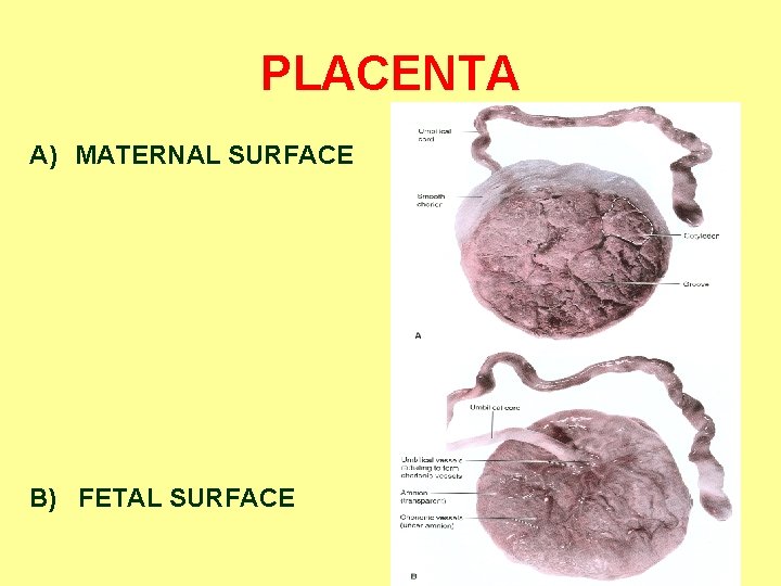 PLACENTA A) MATERNAL SURFACE B) FETAL SURFACE 