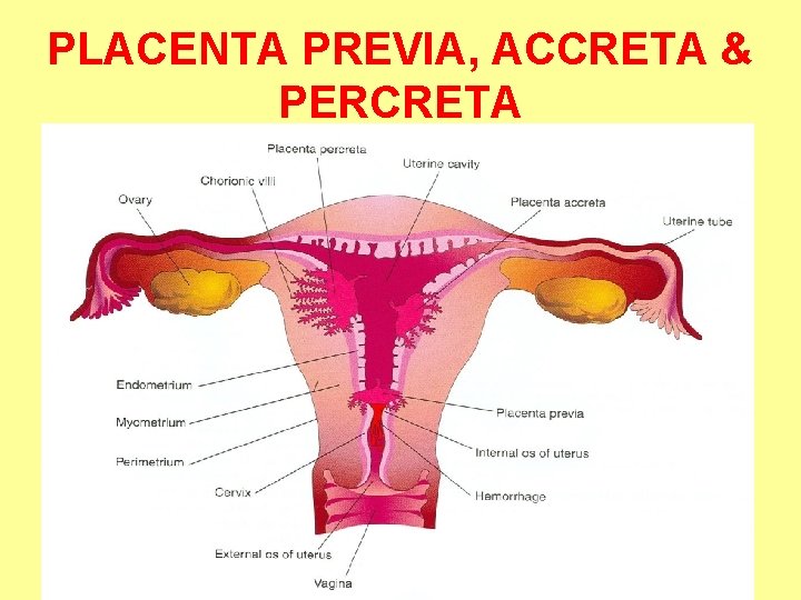 PLACENTA PREVIA, ACCRETA & PERCRETA 