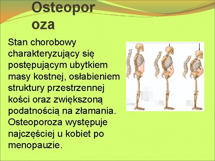 Osteopor oza Stan chorobowy charakteryzujący się postępującym ubytkiem masy kostnej, osłabieniem struktury przestrzennej kości