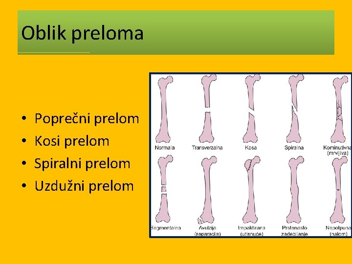 Oblik preloma • • Poprečni prelom Kosi prelom Spiralni prelom Uzdužni prelom 