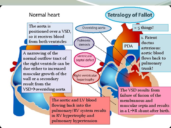 The aorta is positioned over a VSD, so it receives blood from both ventricles