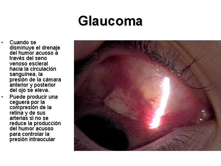 Glaucoma • • Cuando se disminuye el drenaje del humor acuoso a través del