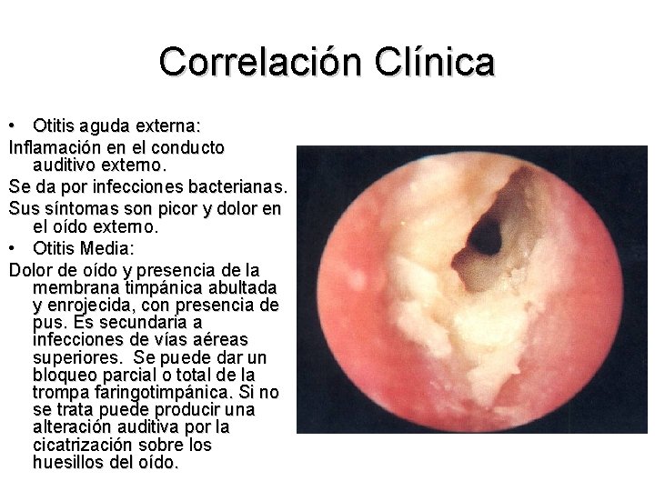 Correlación Clínica • Otitis aguda externa: Inflamación en el conducto auditivo externo. Se da