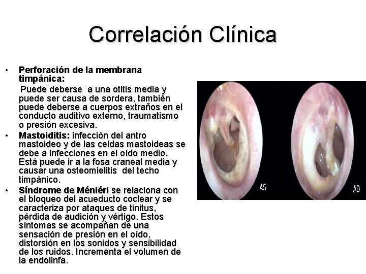 Correlación Clínica • • • Perforación de la membrana timpánica: Puede deberse a una