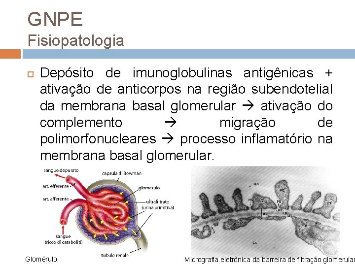 GNPE Fisiopatologia Depósito de imunoglobulinas antigênicas + ativação de anticorpos na região subendotelial da