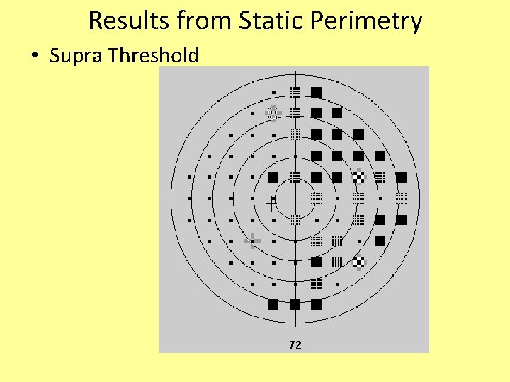 Results from Static Perimetry • Supra Threshold 
