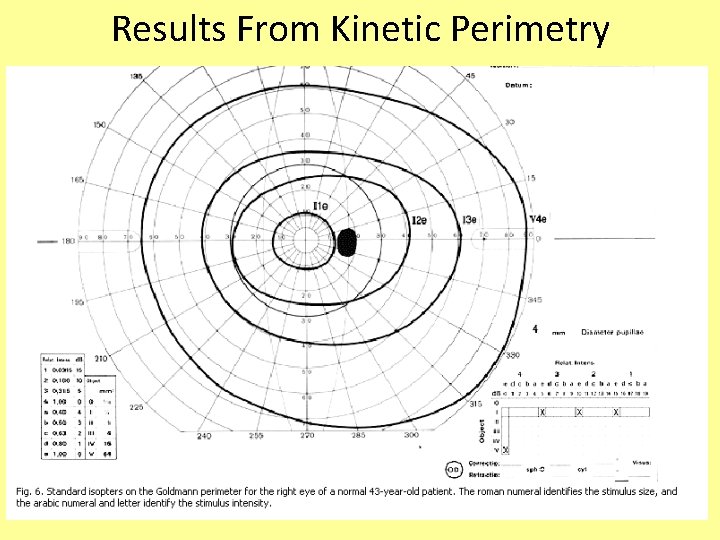 Results From Kinetic Perimetry 