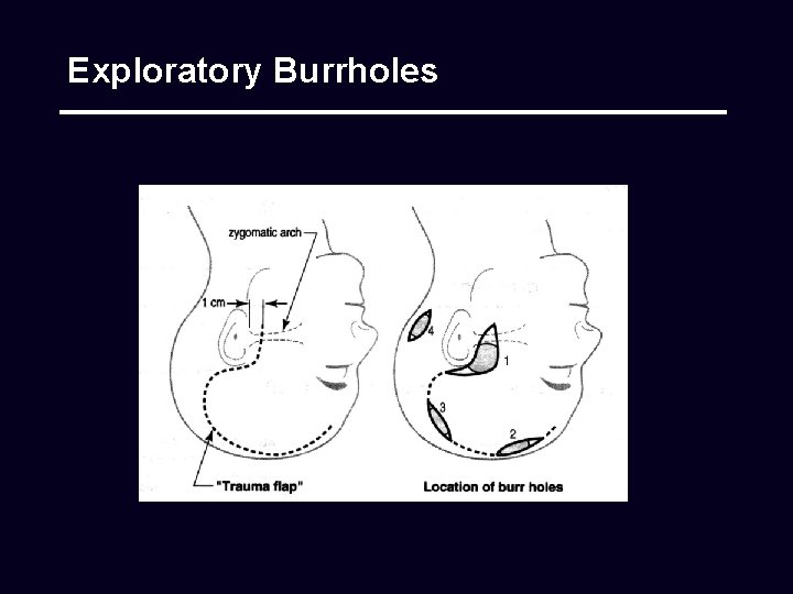 Exploratory Burrholes 