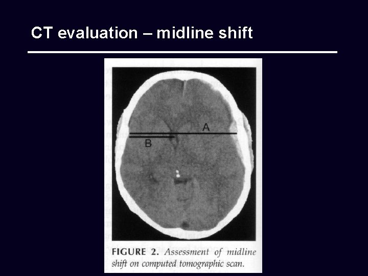 CT evaluation – midline shift 