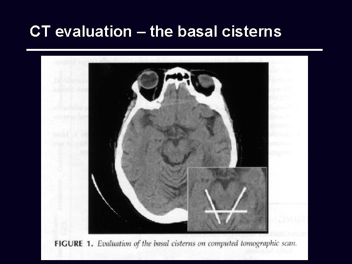 CT evaluation – the basal cisterns 