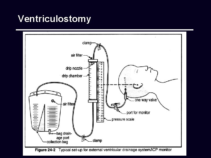 Ventriculostomy 