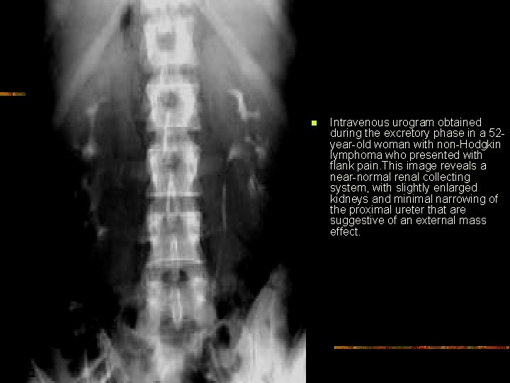 n Intravenous urogram obtained during the excretory phase in a 52 year-old woman with