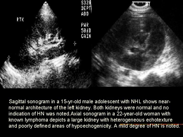 Sagittal sonogram in a 15 -yr-old male adolescent with NHL shows nearnormal architecture of