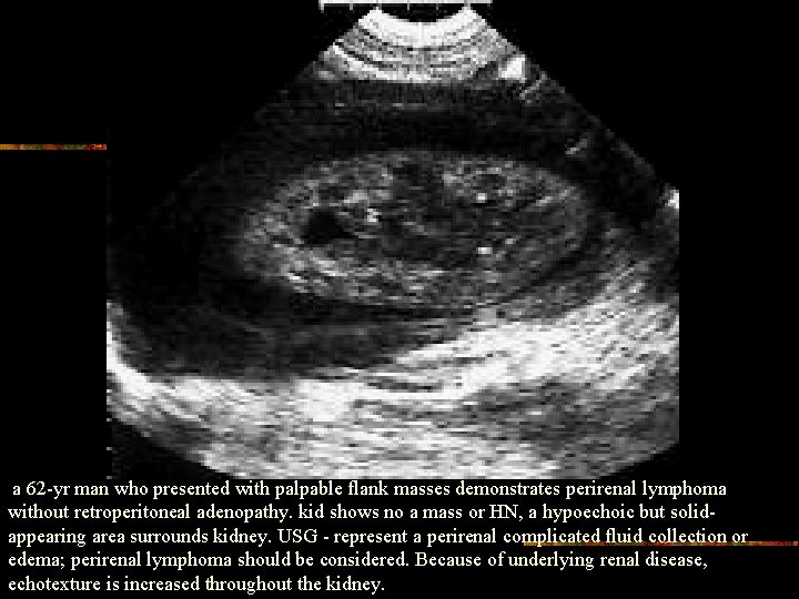 a 62 -yr man who presented with palpable flank masses demonstrates perirenal lymphoma without