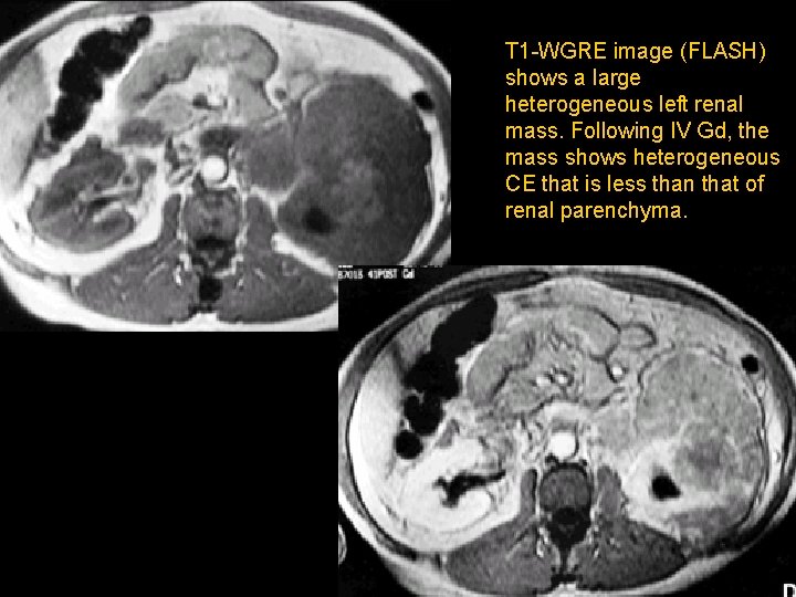 T 1 -WGRE image (FLASH) shows a large heterogeneous left renal mass. Following IV