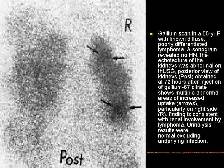 n Gallium scan in a 55 -yr F with known diffuse, poorly differentiated lymphoma.