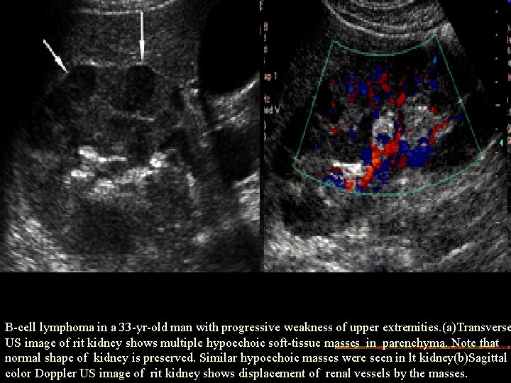 B-cell lymphoma in a 33 -yr-old man with progressive weakness of upper extremities. (a)Transverse