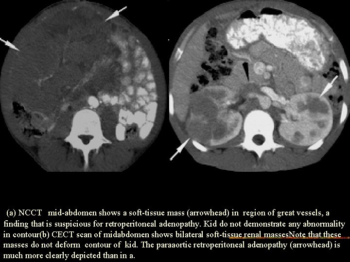 (a) NCCT mid-abdomen shows a soft-tissue mass (arrowhead) in region of great vessels, a