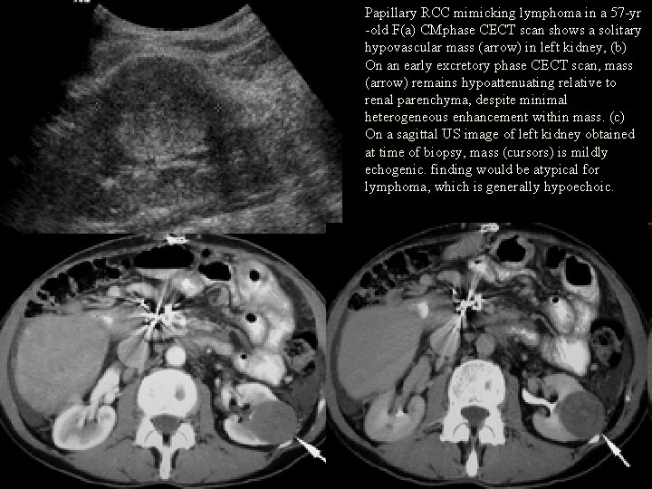 Papillary RCC mimicking lymphoma in a 57 -yr -old F(a) CMphase CECT scan shows