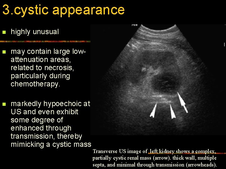 3. cystic appearance n highly unusual n may contain large lowattenuation areas, related to