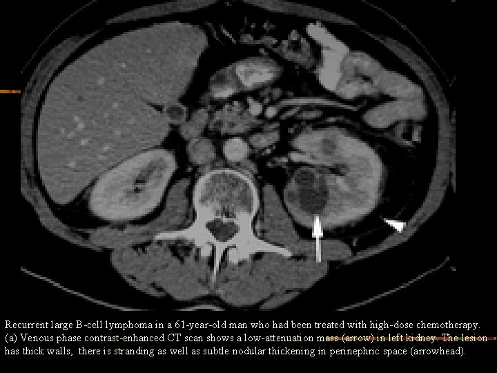 Recurrent large B-cell lymphoma in a 61 -year-old man who had been treated with